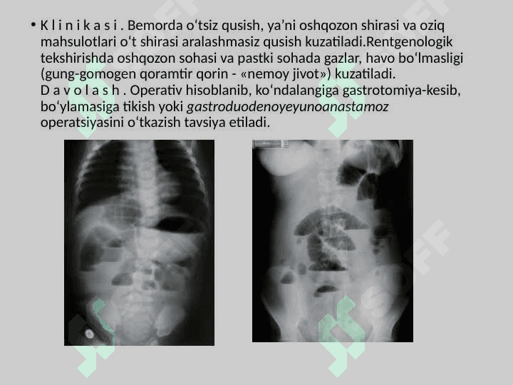 Yuqori va pastki ichak tutilishlari xammasi 6