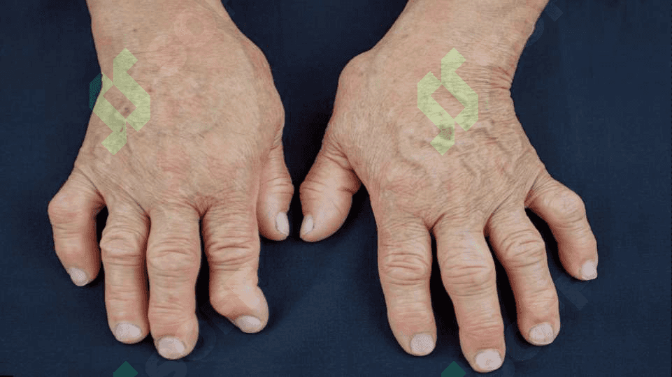Deformatsiyalovchi osteoartroz 5