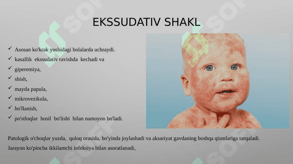 Atopik  dermatit 8