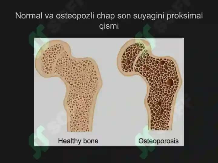 Osteoporoz kasalligi 3