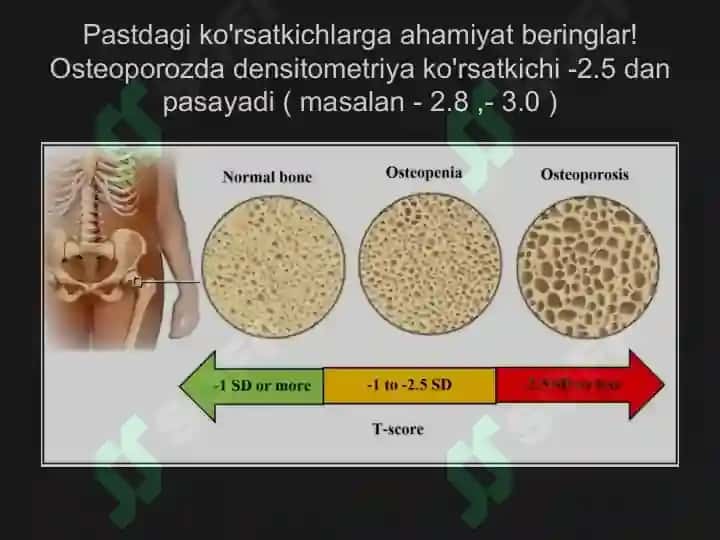 Osteoporoz kasalligi 4