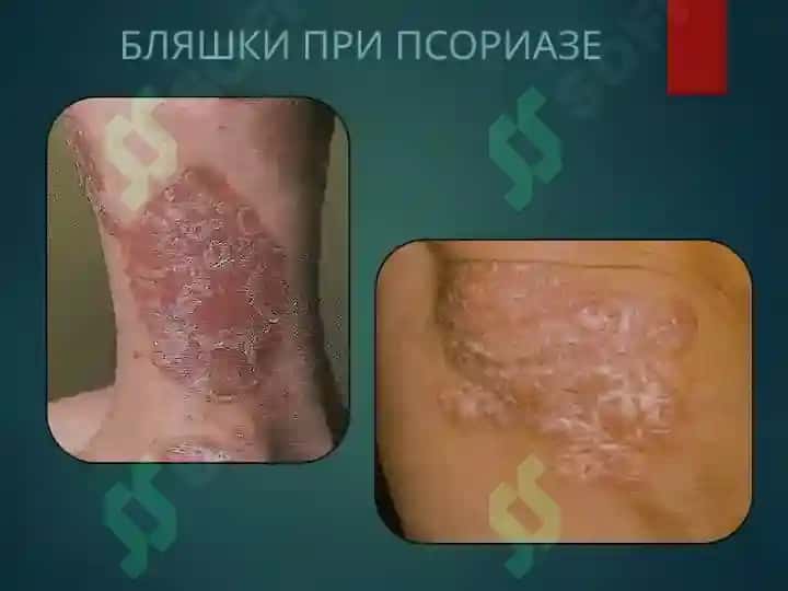 Псориаз 2