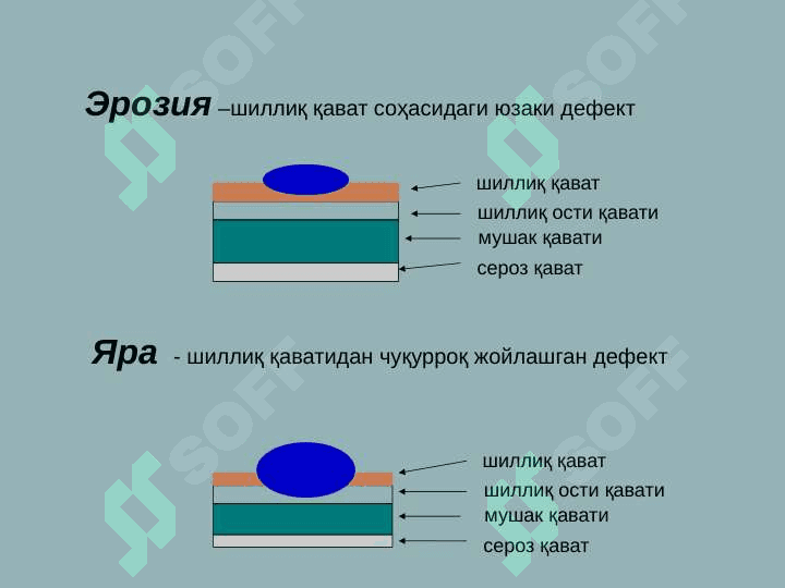 Oshqozon o'tkir yaralari va eroziyalari 4