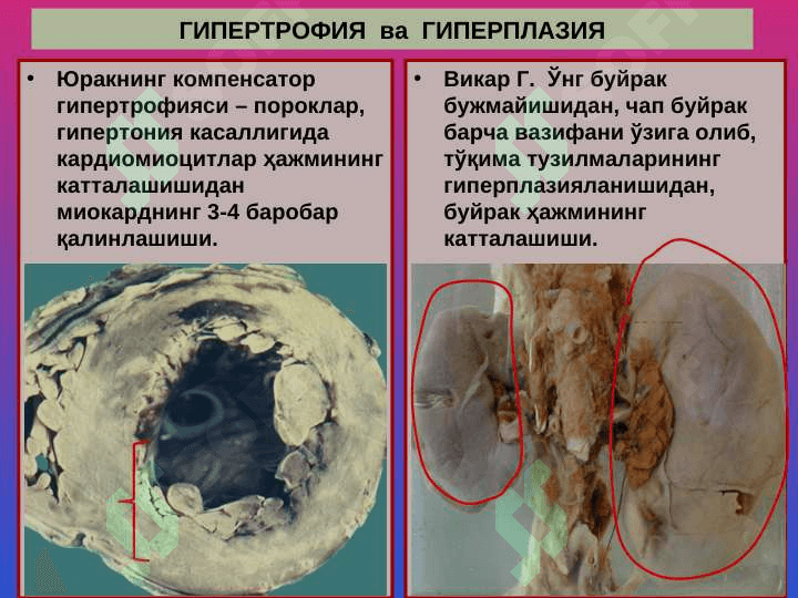 Мосланиш-ўрин алмашиниш жараёнлари. Гипертрофия, атрофия, гиперплазия, метаплазия, дисплазия 8