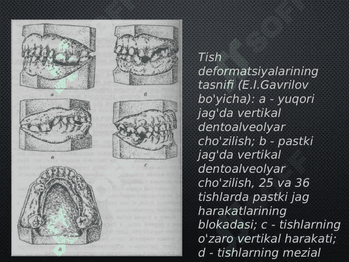 Tish qatori deformatsiyalarini Gavrilov 
va Ponomaryova bo'yicha tasniflari 4