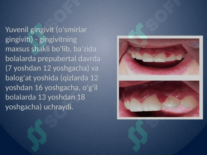 Yuvenil gingivit 2