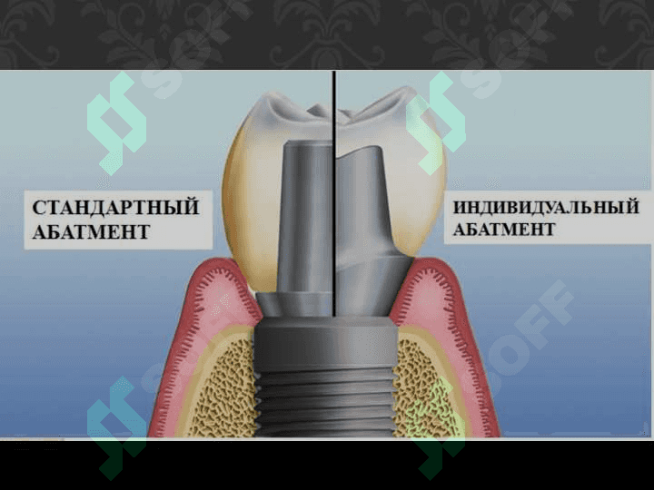 Tish implantlari  tasnifi 6