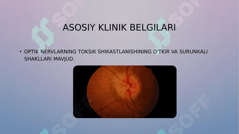 Ko'ruv nervining 
toksik zararlanishi 6
