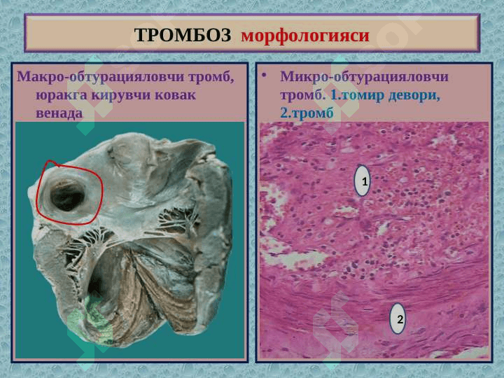 Tromboz . Emboliya . Staz . Infarkt . 8