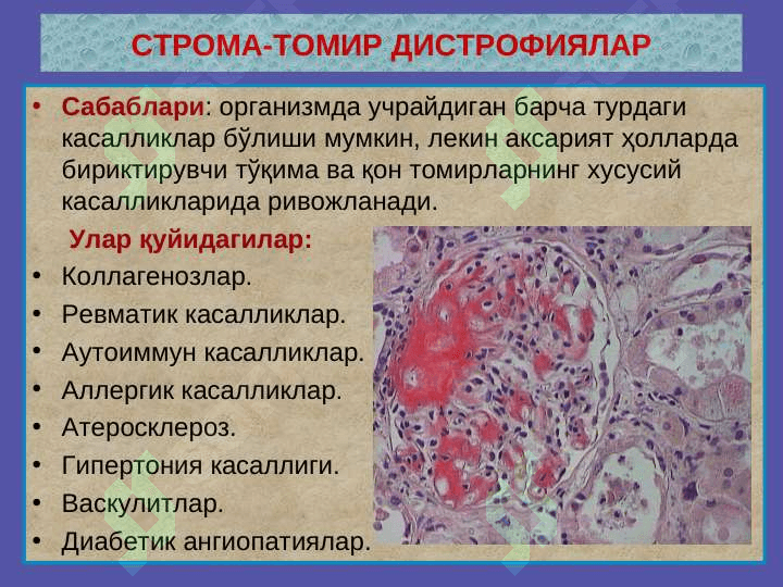 Stroma va tomir distrofiyalari . Distrofiya - distrr=ofiyalar 3