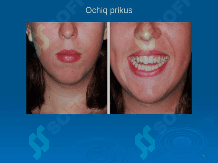 Ochiq prikus 4