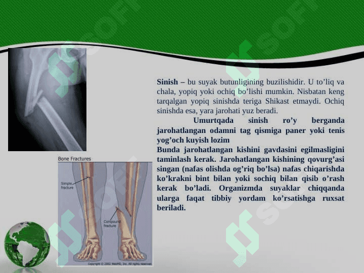 Suyak singanida birinchi yordam ko’rsatish 7
