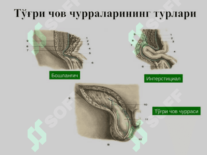 Чов, сон, киндик ва қорин оқ чизиғи чурралари 7