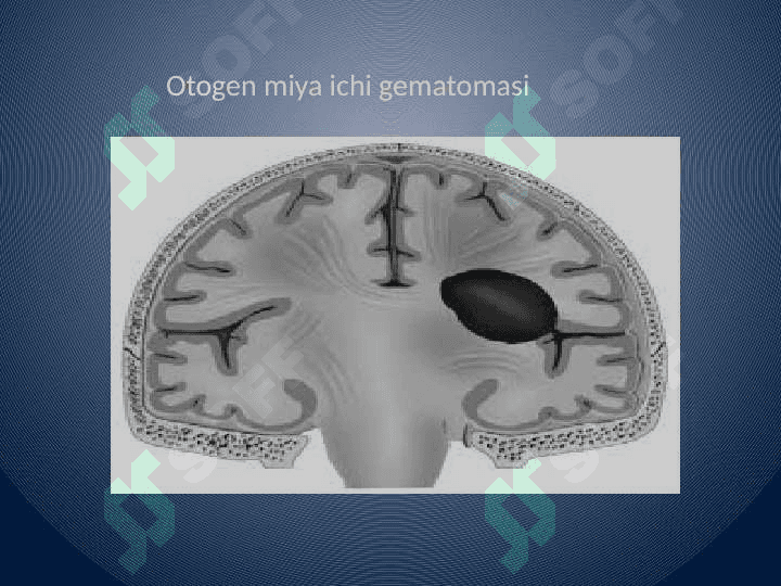 Otogen miya ichi gematomasida
 nevrologik simptomlar 4