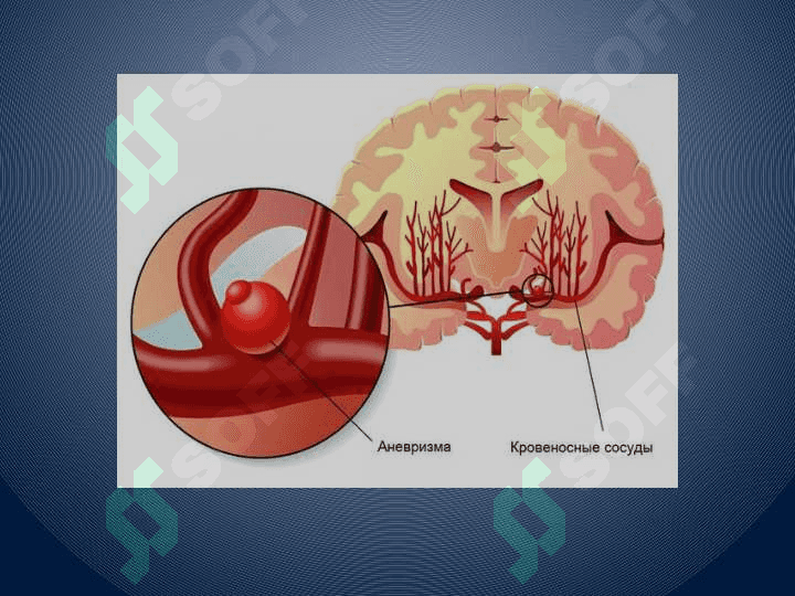 Otogen miya ichi gematomasida
 nevrologik simptomlar 7