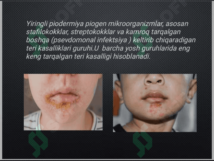 Og'iz atrofi
yiringli piodermiyasi 2
