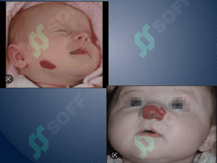 Bolalarda yuz
yumshoq to'qimalarining o'smasimon xosilalari xavfsiz o'smalar 3