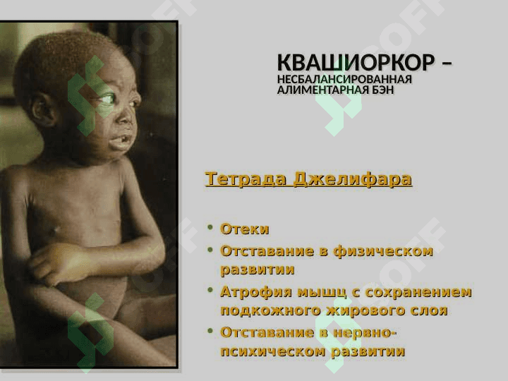 Типовые нарушения обмена белков и нуклеиновых кислот 8