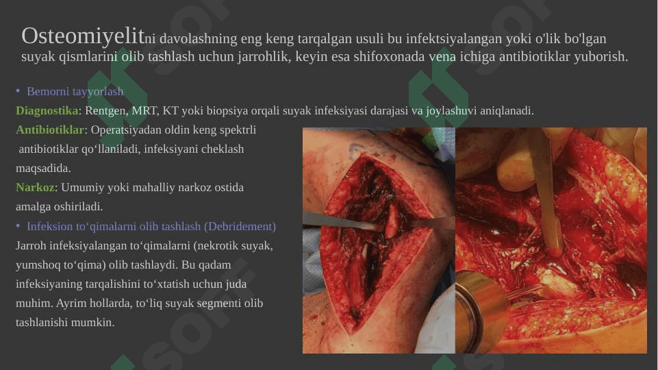 OSTEOMIYELITDA BAJARILADIGAN OPERATSIYA 2