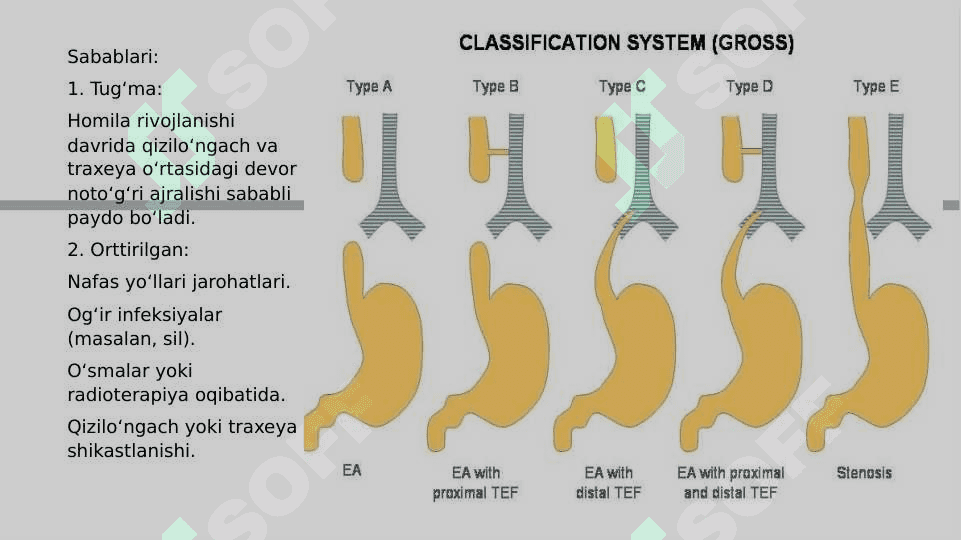Traxeoezofagial fistula 4