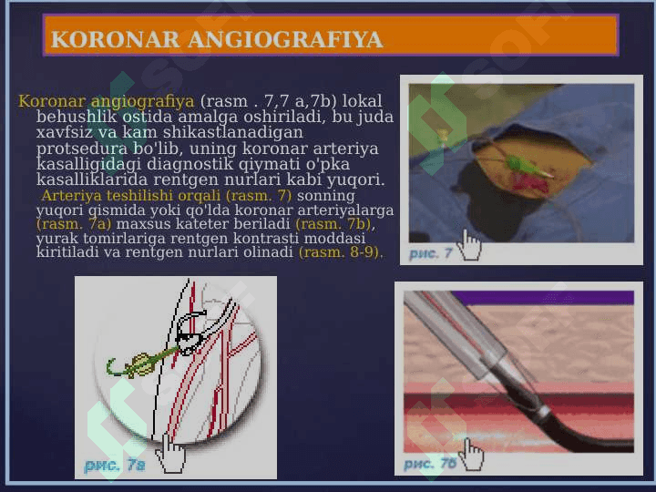 Yurak ishemik kasalliklarini operativ davolashning zamonaviy usullari 5