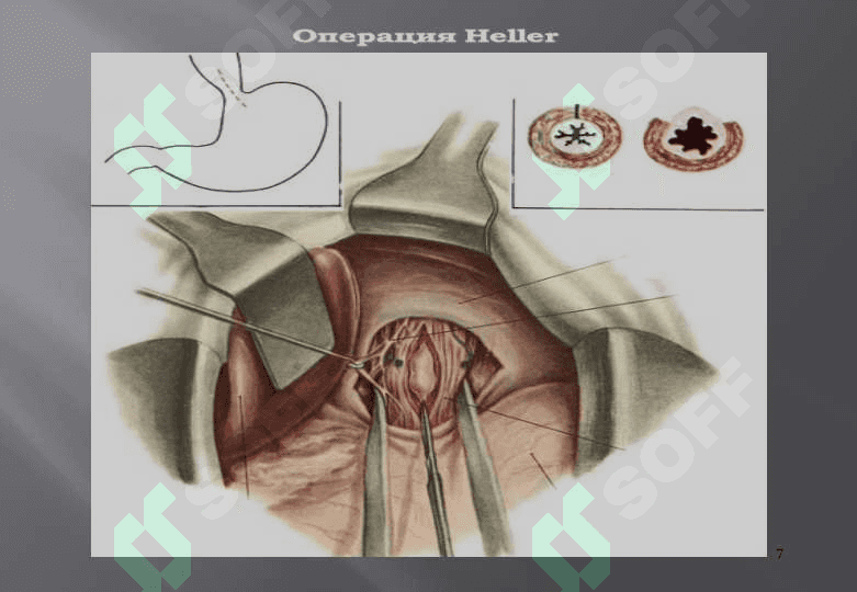 Qizilo`ngachning tug`ma va orttirilgan nuqsonlari xirurgiyasi 7