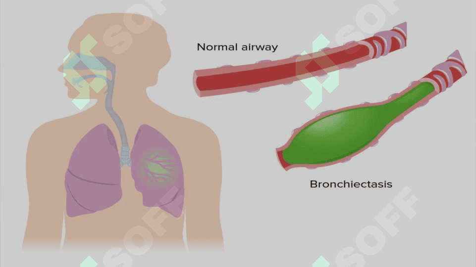 Bronxoektatik kasallik: etiologiya, patogenez, patomorfologiya, xarakterli simptomlar, og'iz bo'shlig'ida o'ziga xos o'zgarishlar parhez va              medikamentoz davolash. 3