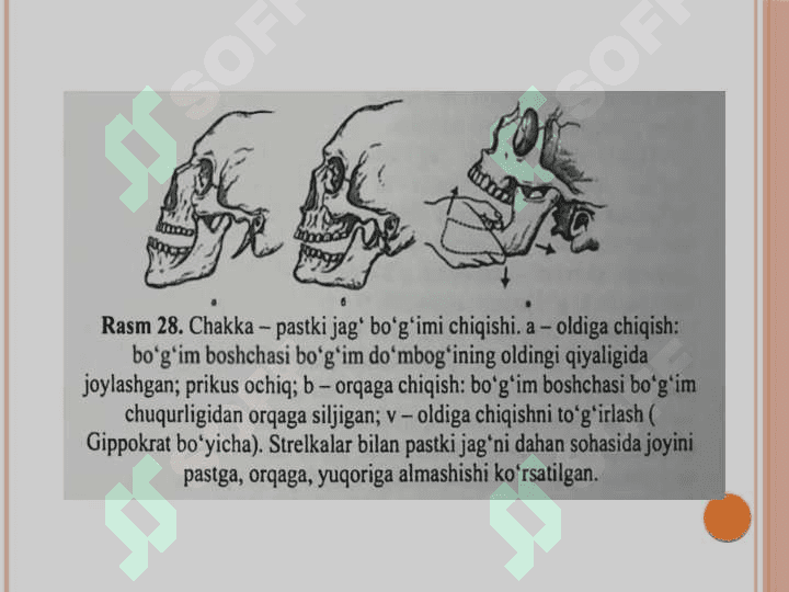 Pastki jagʻ chiqishida kuzatiladigan       asoratlar va davolash usullari 4