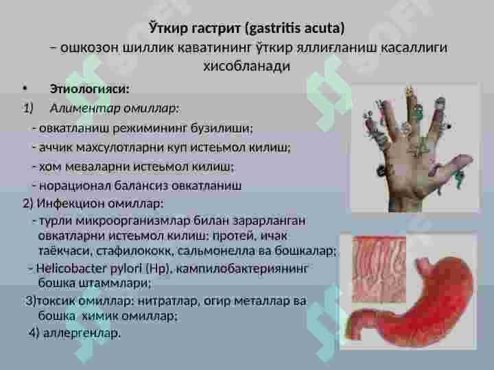 SURUNKALI GASTRIT 2