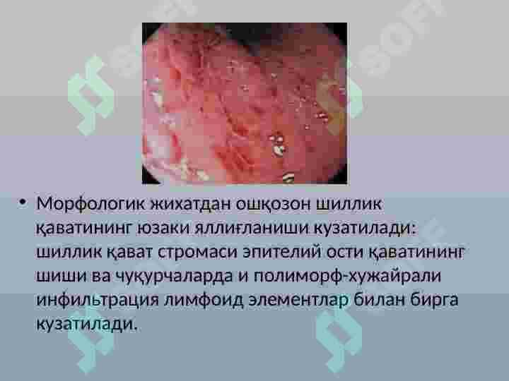 SURUNKALI GASTRIT 3
