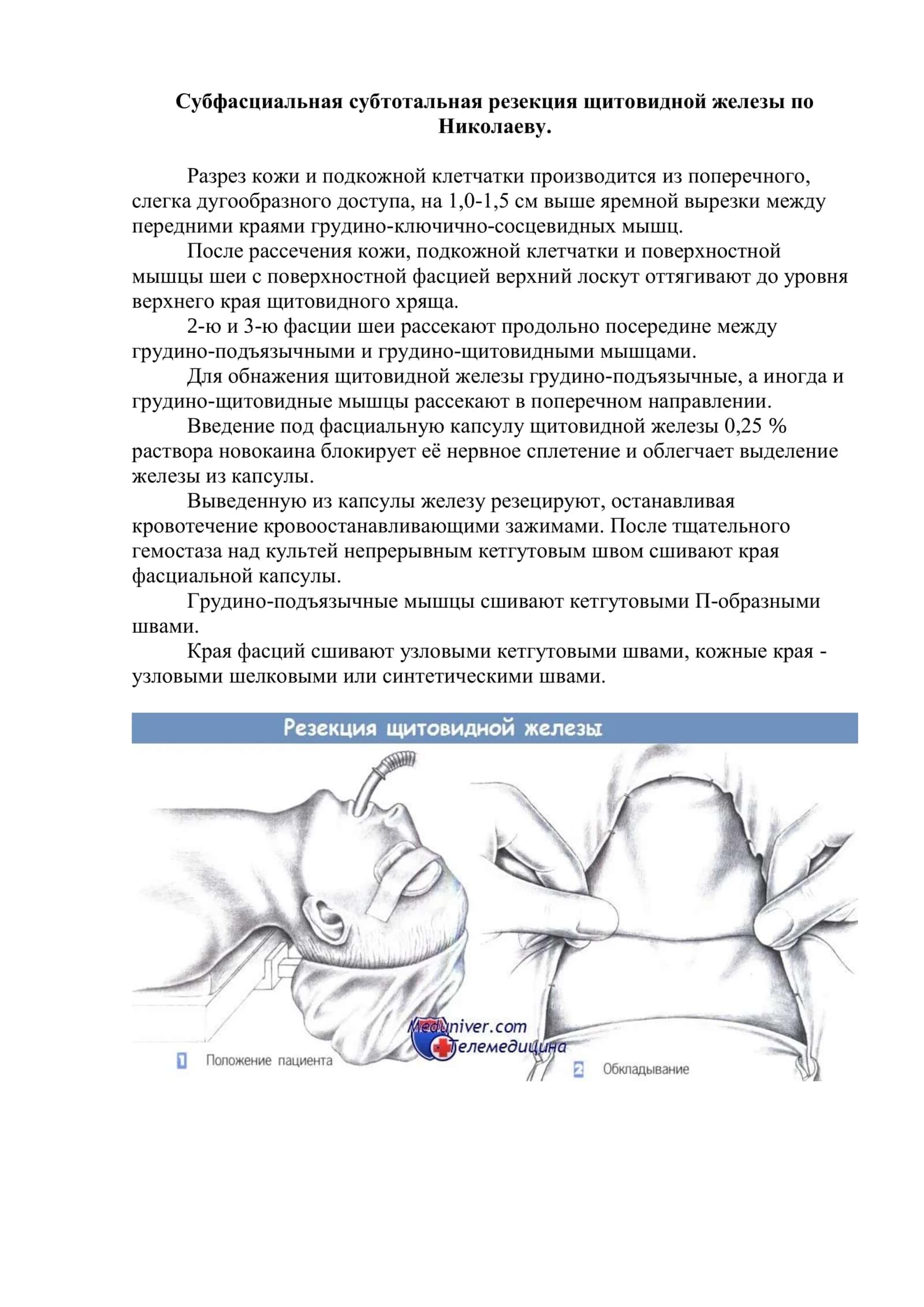 Субфасциальная субтотальная резекция щитовидной железы по Николаеву 1