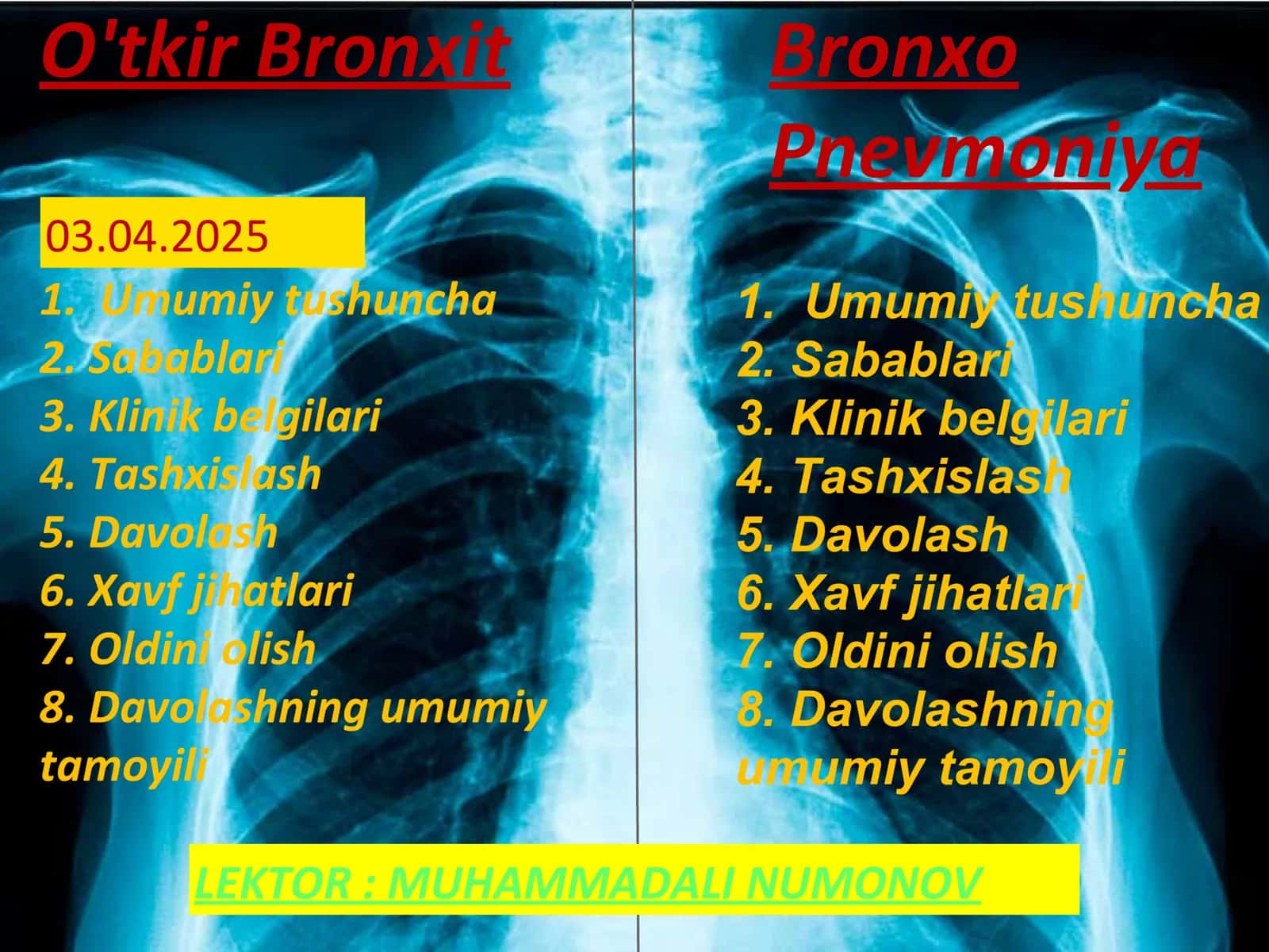 O'tkir Bronxit 1