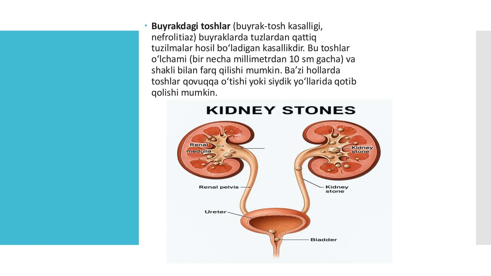 Buyraklarda urat toshlarining hosil bulishi va davolash yo'llari 2