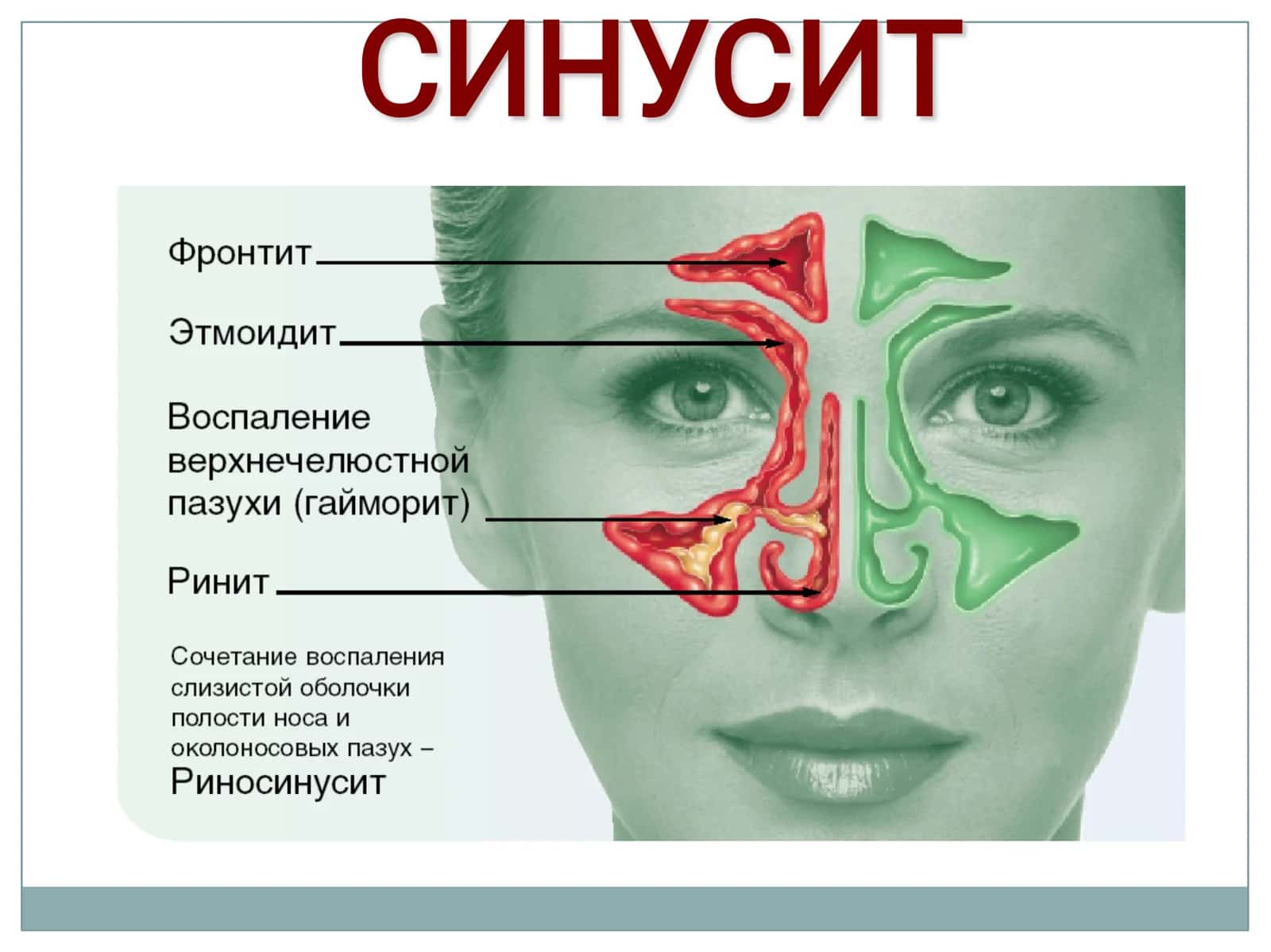 Синуситлар ва бурун ўсмалари 2