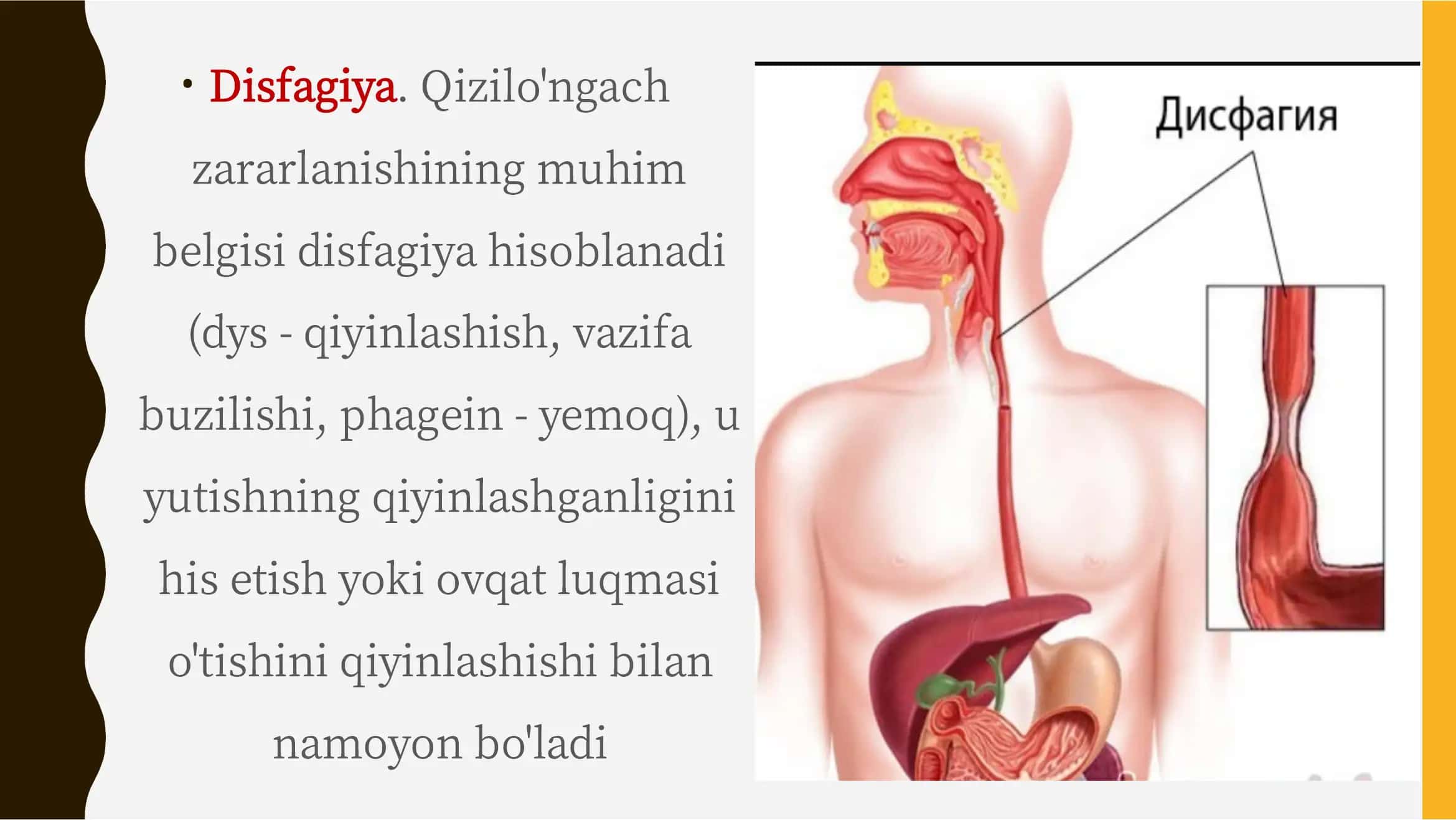 Disfagiya 2