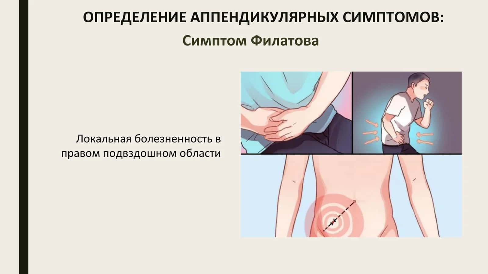 Ректальное исследование при тазовом аппендиците 2