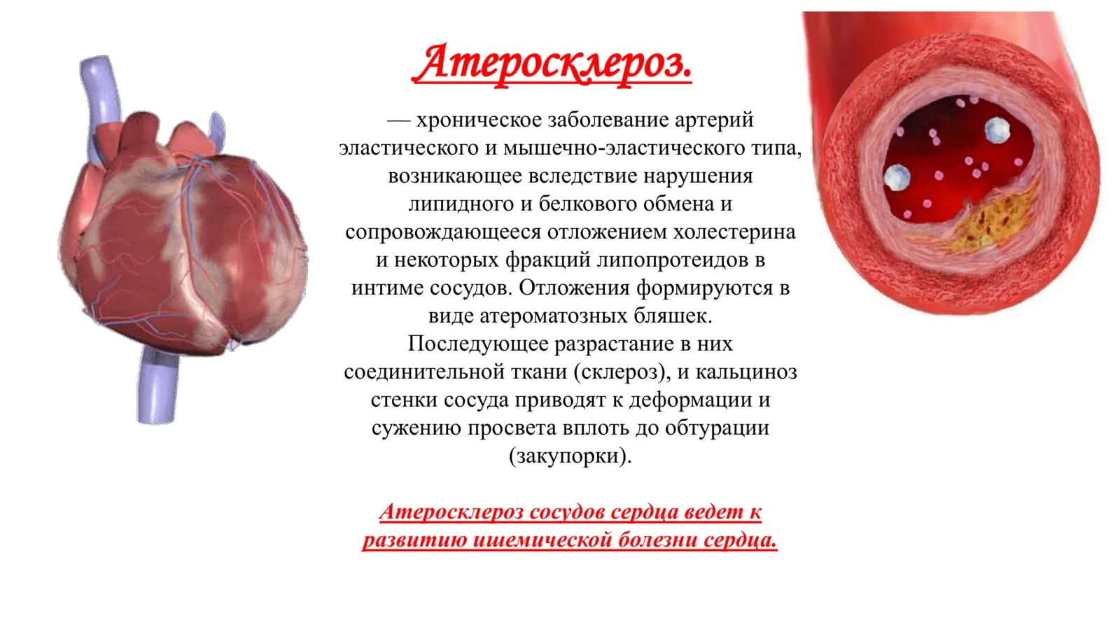 Атеросклероз 2