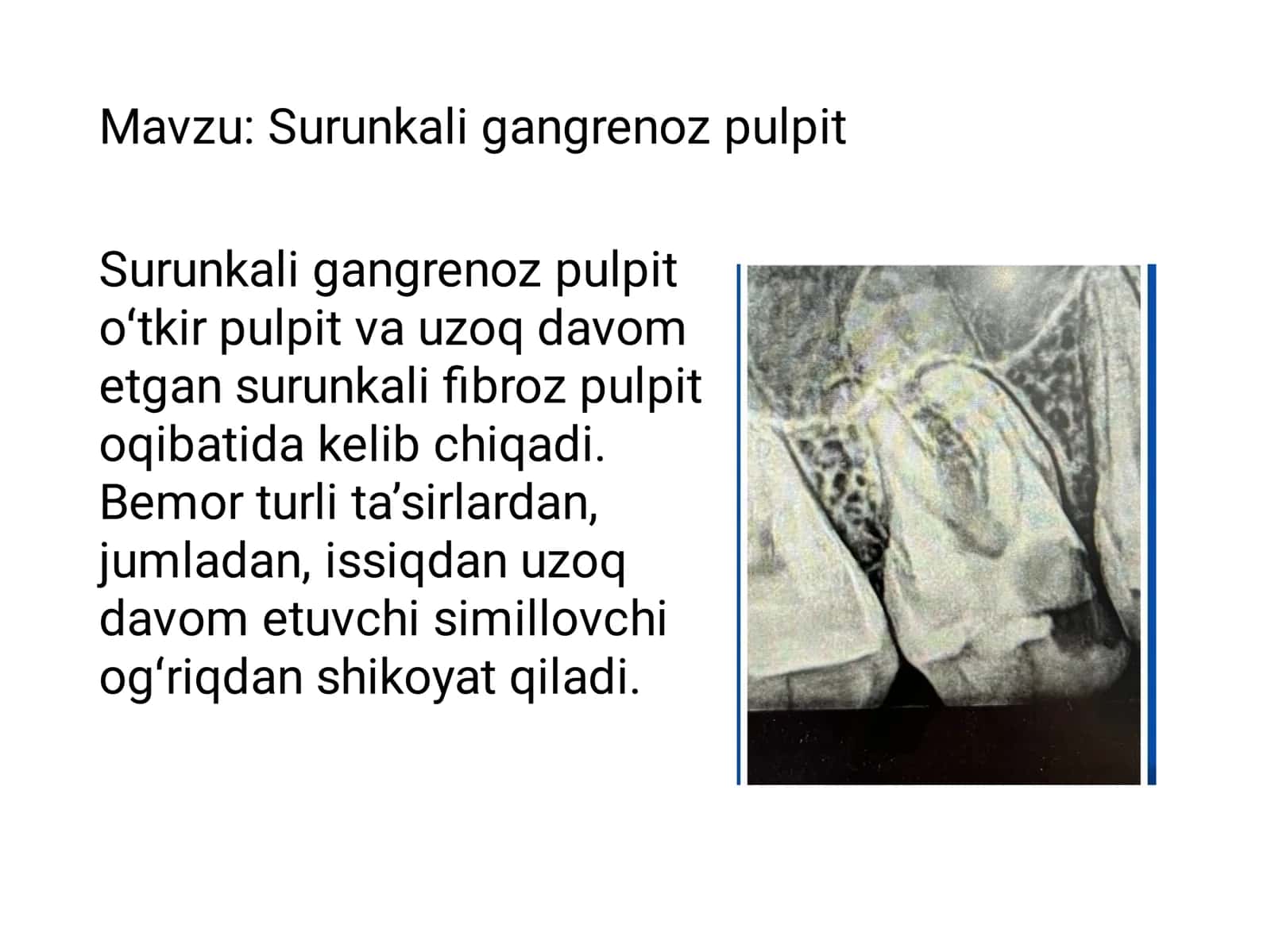 Endodontiya gangrenoz pulpi 2