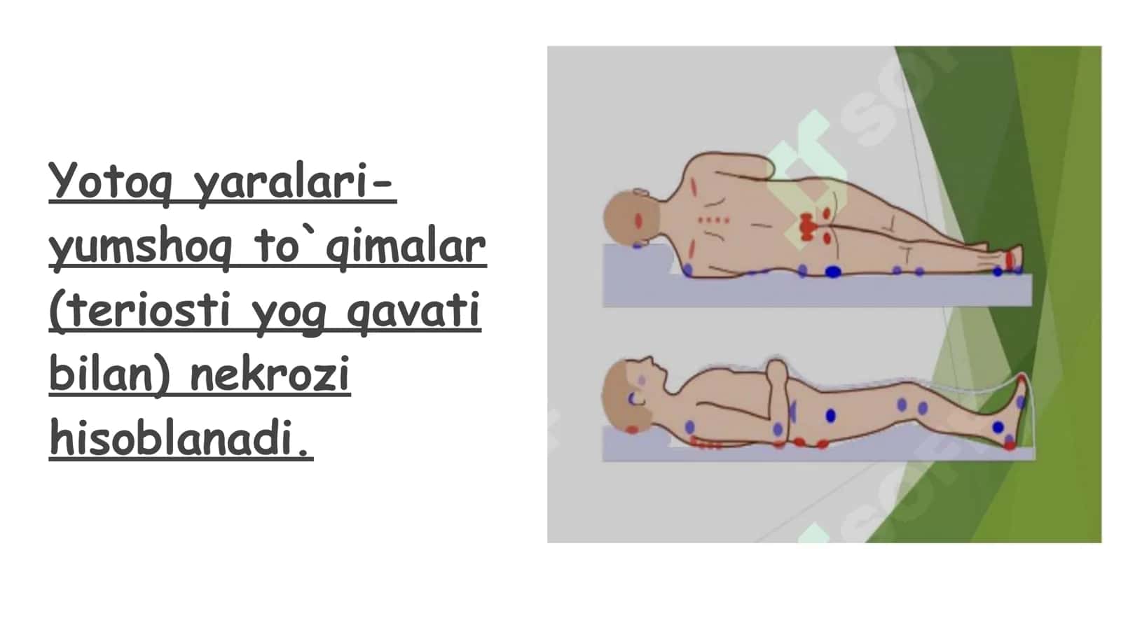 Yotoq yaralari va ularni kelib chiqishi 2