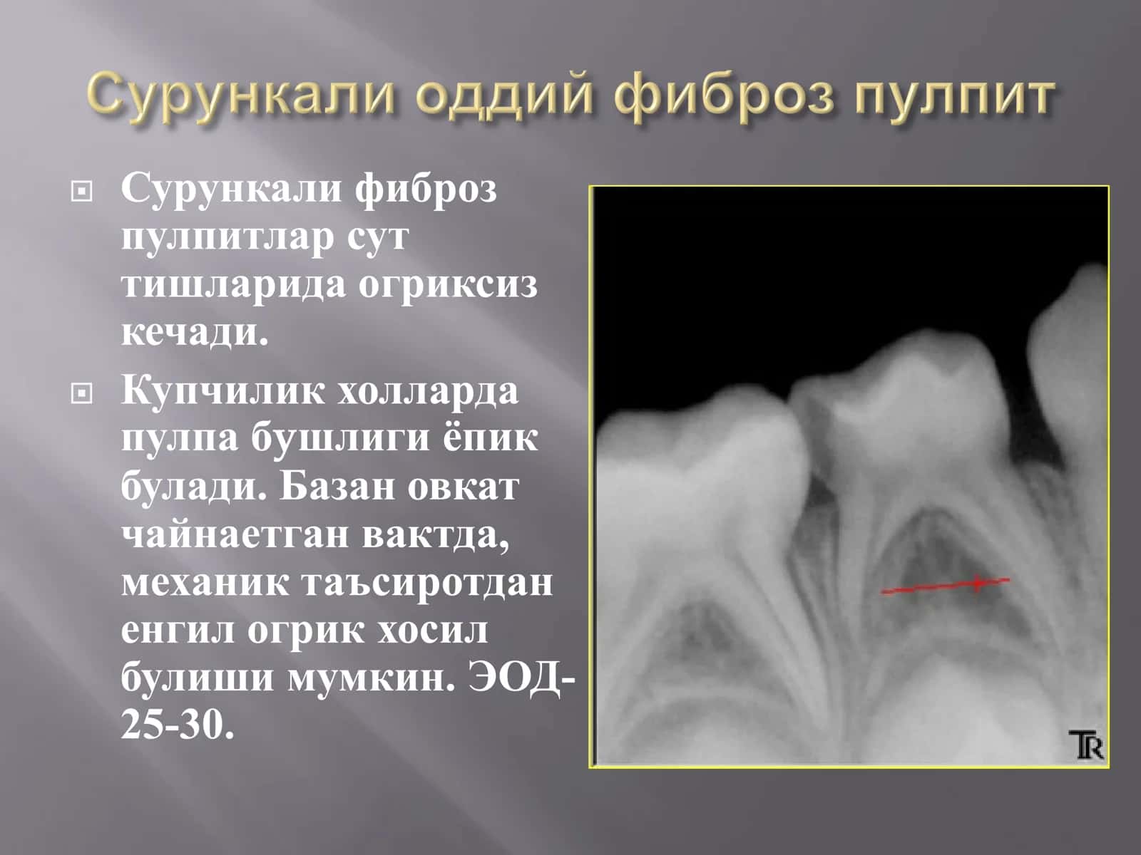 Сут тишларда кечувчи сурункали пульпитларга 2