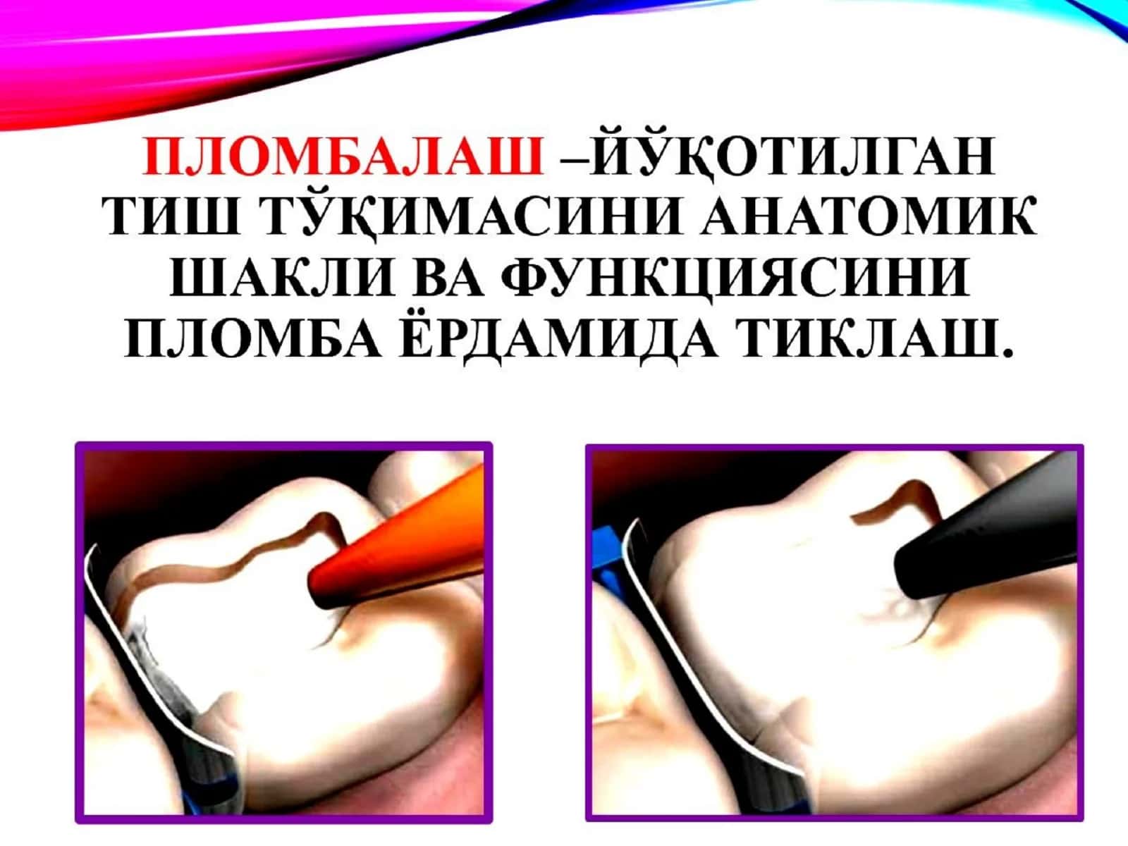 Terapevtik stomatologiyada doimiy plomba ashyolari (slayd / prezintatsiya / taqdimot / mustaqil ish ) 2