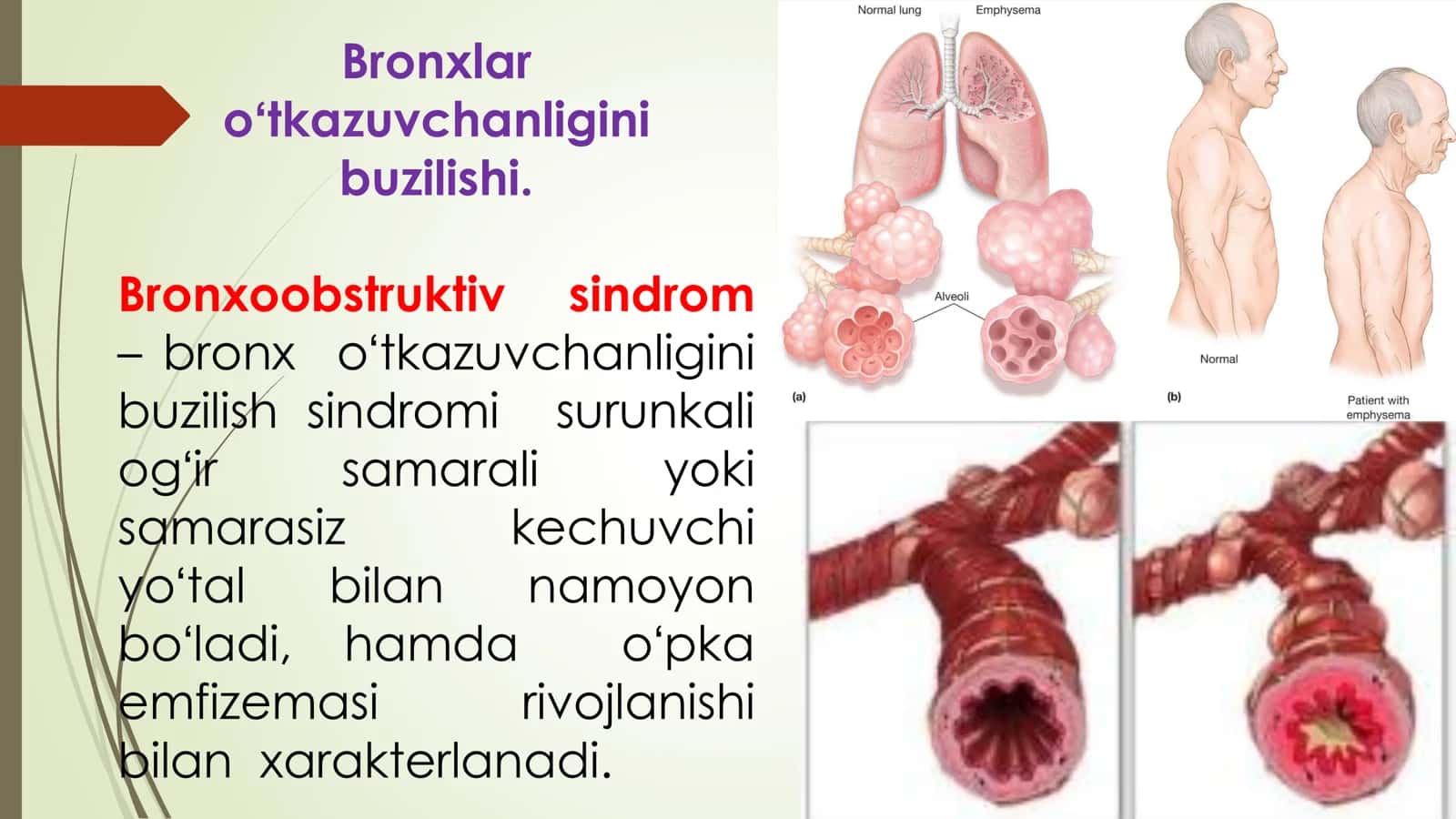 Bronxoobstruktiv sindromning differensial diagnostikasi 2