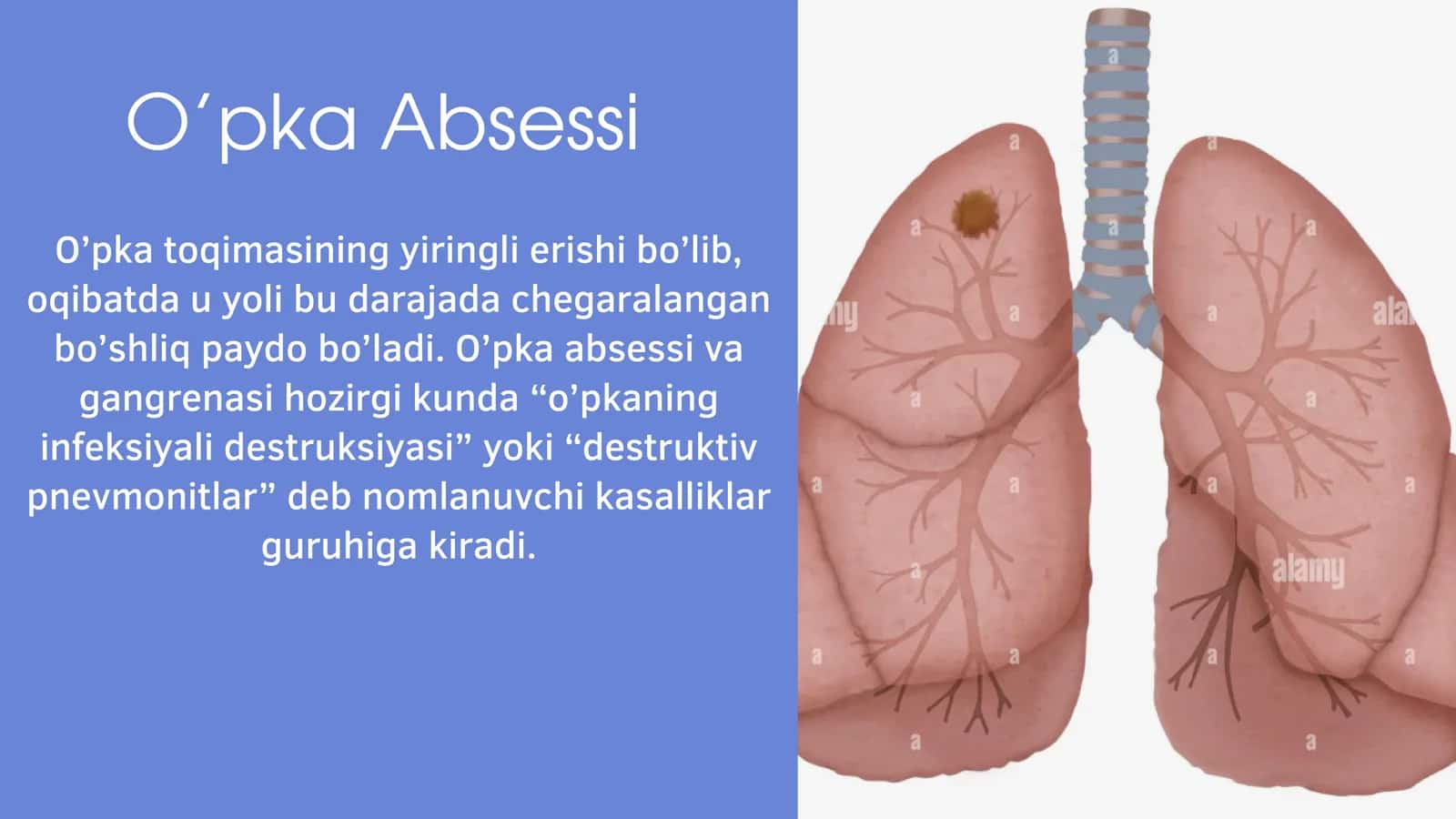 O'pka absessi 2