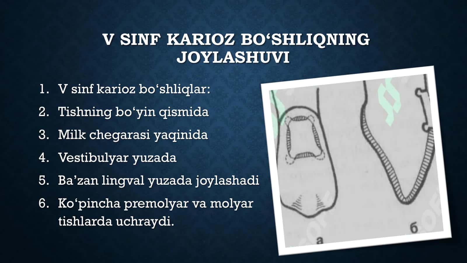 Fantomlarda 5 sinf karioz bo'shliqlarini charxlash va plombalash 2