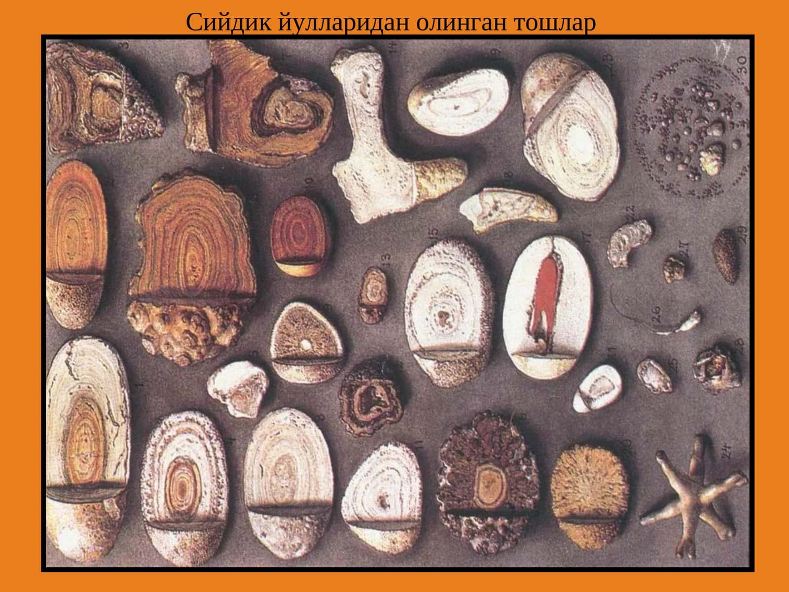 Сийдик тош касаллиги (СТК) 3