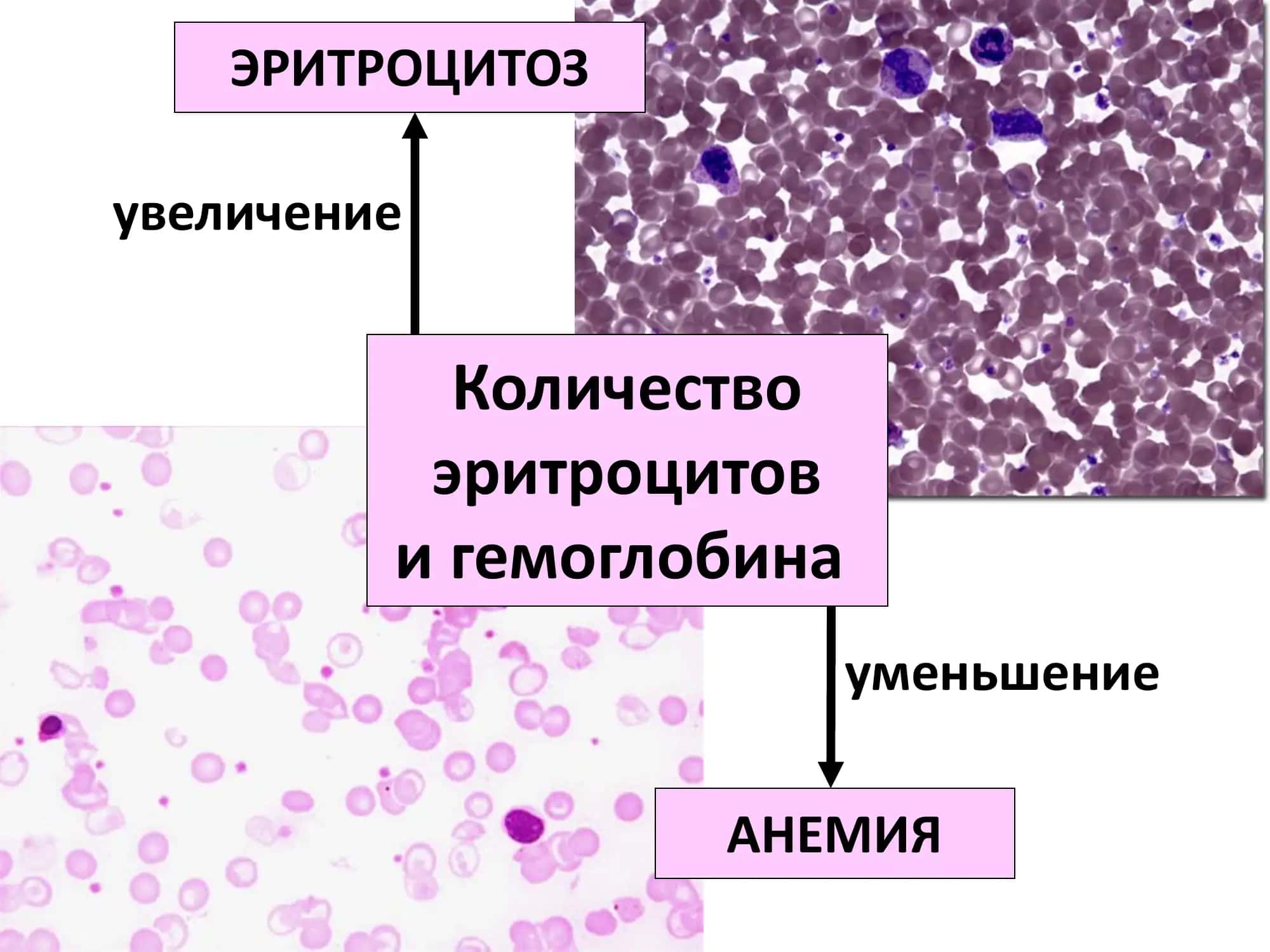 Патофизиология  эритропоэза.  Анемии. 3