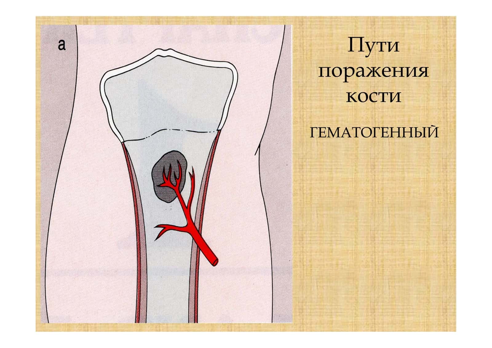 Остеомиелит 3