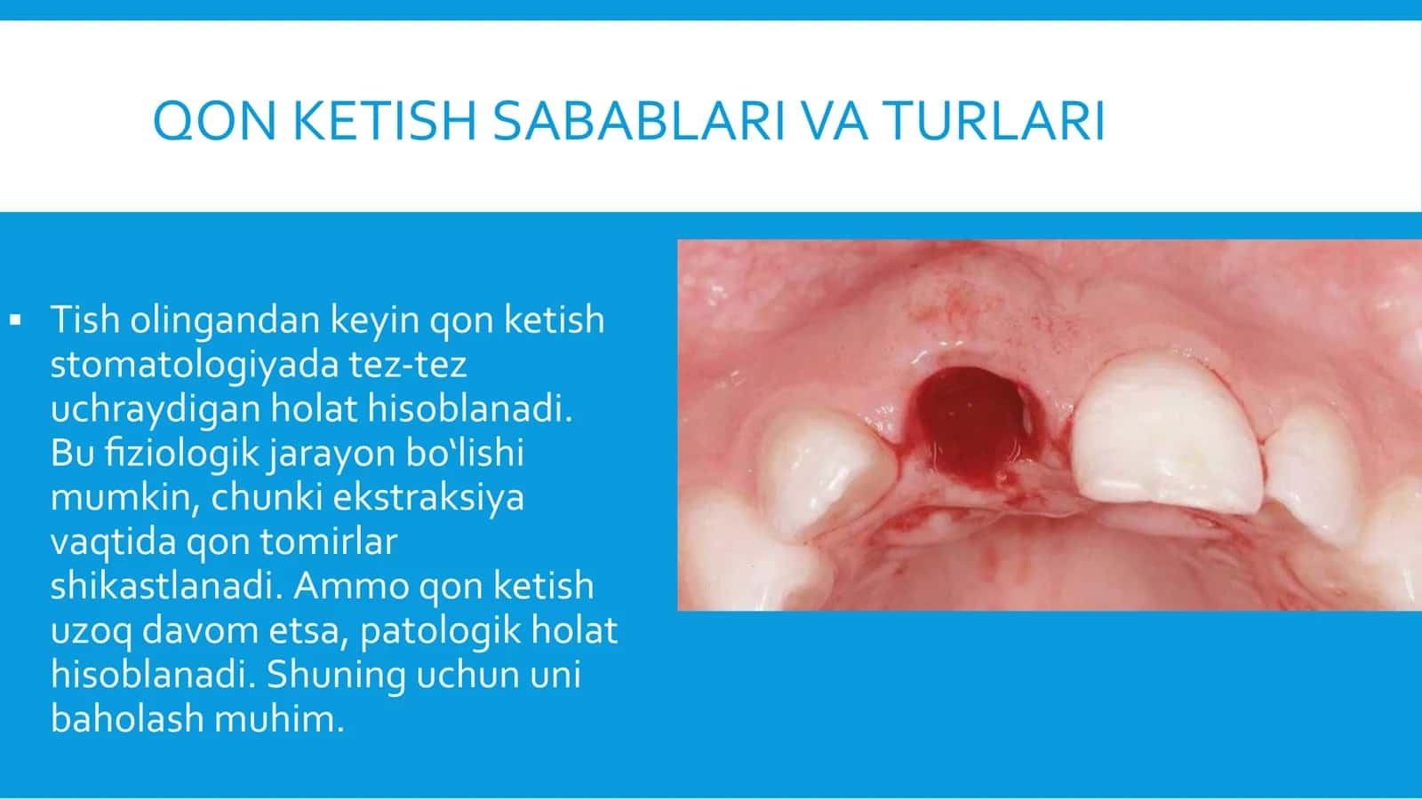 Tish olingandan keyin qon ketish sabablari va turlari 3