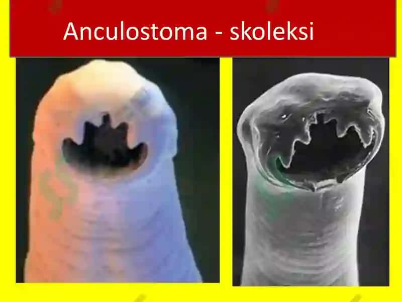 YUMALOQ CHUVALCHANGLAR-ODAM PARAZITLARI EGRI BOSHLI GIJJA, TRIXINELLA, RISHTA 3