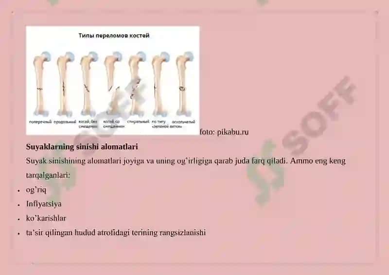 Suyak sinishining turlari 4